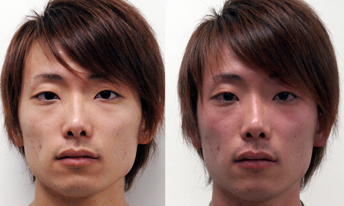 Why do Asians blush easily when drinking alcohol?