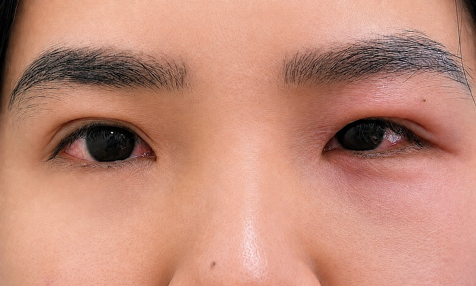 7 conditions that cause red eyes