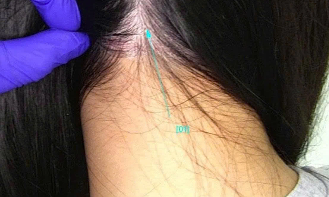White scalp flakes due to chronic dermatitis