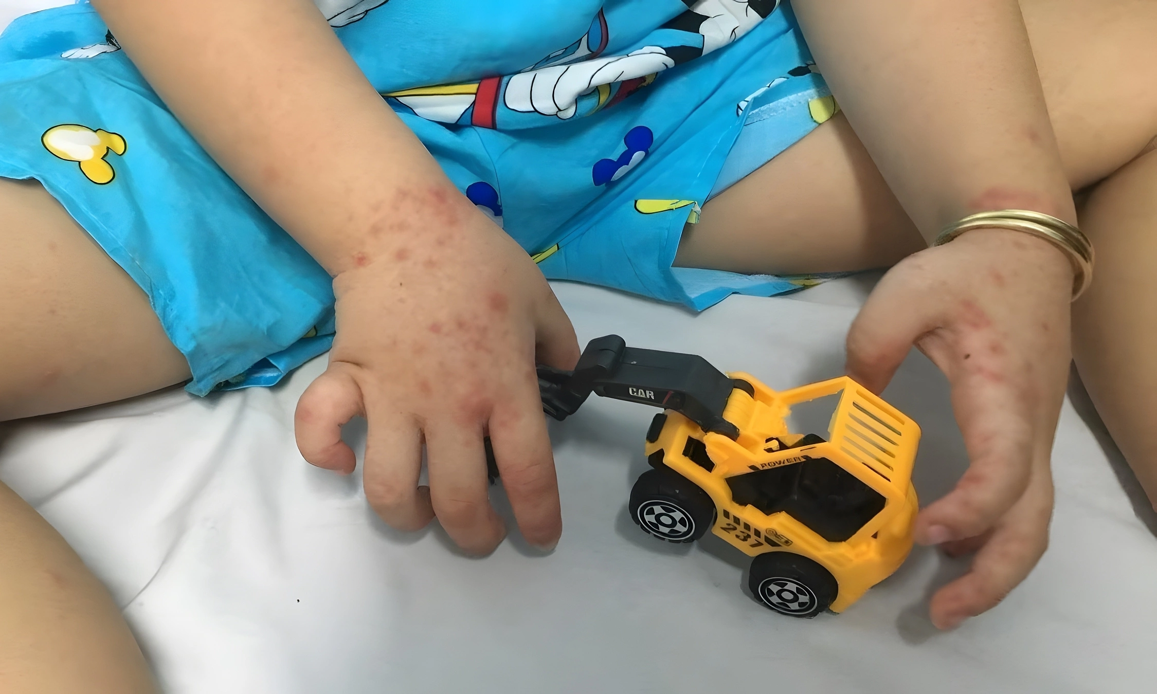 5 easily misunderstood signs when children contract hand, foot, and mouth disease