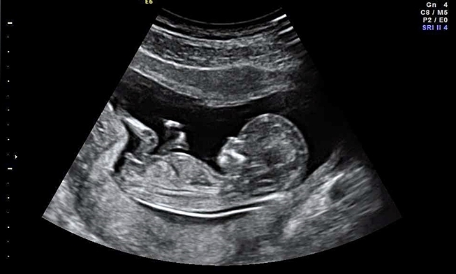 Gay couple nearly loses parental rights over 'male child only' surrogacy clause