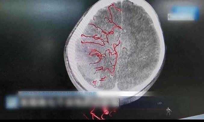 10-year-old boy suffers partial paralysis after self-extracting decayed tooth