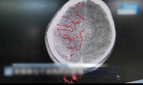 10-year-old boy suffers partial paralysis after self-extracting decayed tooth