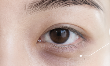 Why do eye bags appear?
