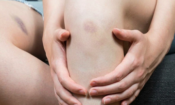 Why your skin bruises easily